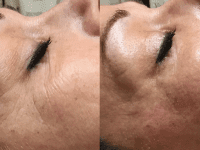 Før og efter billederne er et resultatet efter 4 behandlinger. Kunden har samtidig fået Ultra concentrated Acid peel (3 behandlinger). Foto: Klinik Rosenvold.